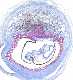 pregnant